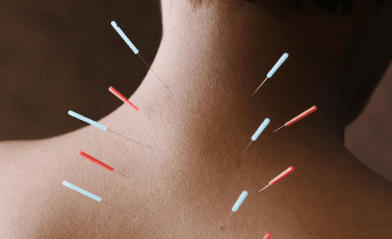 I struggled to move on from a heartbreak — until I tried acupuncture for emotional healing